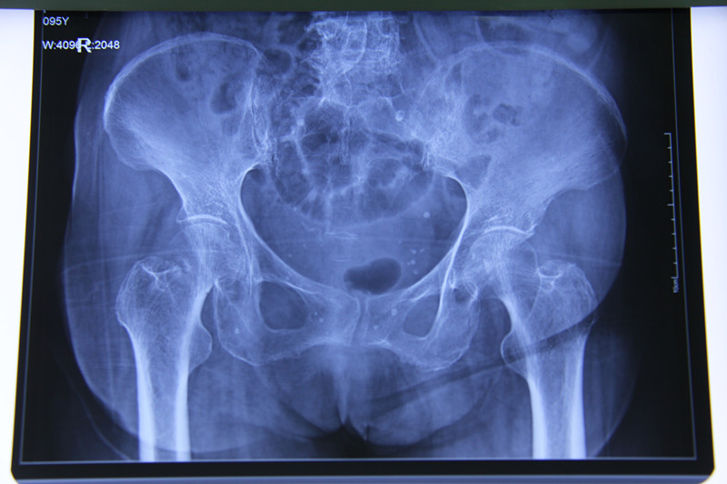 中医院成功为百岁老人实施股骨头置换手术